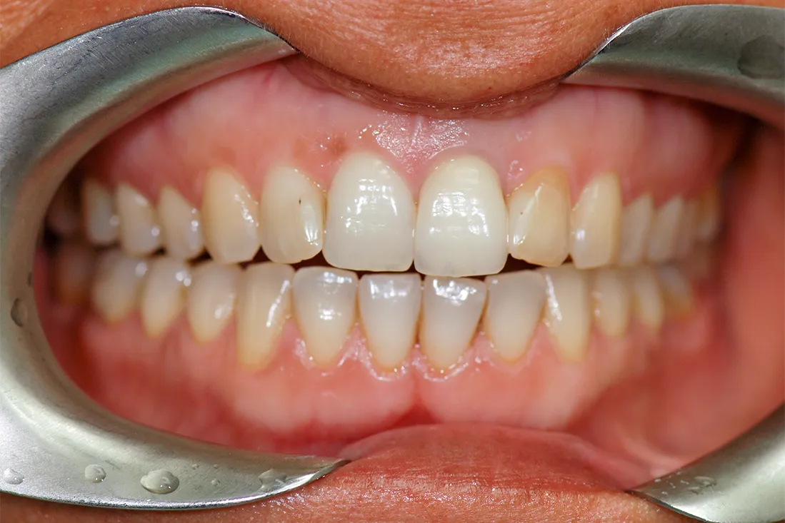 1 Faccette Dentali Frontali Michael Amodio Odontotecnico