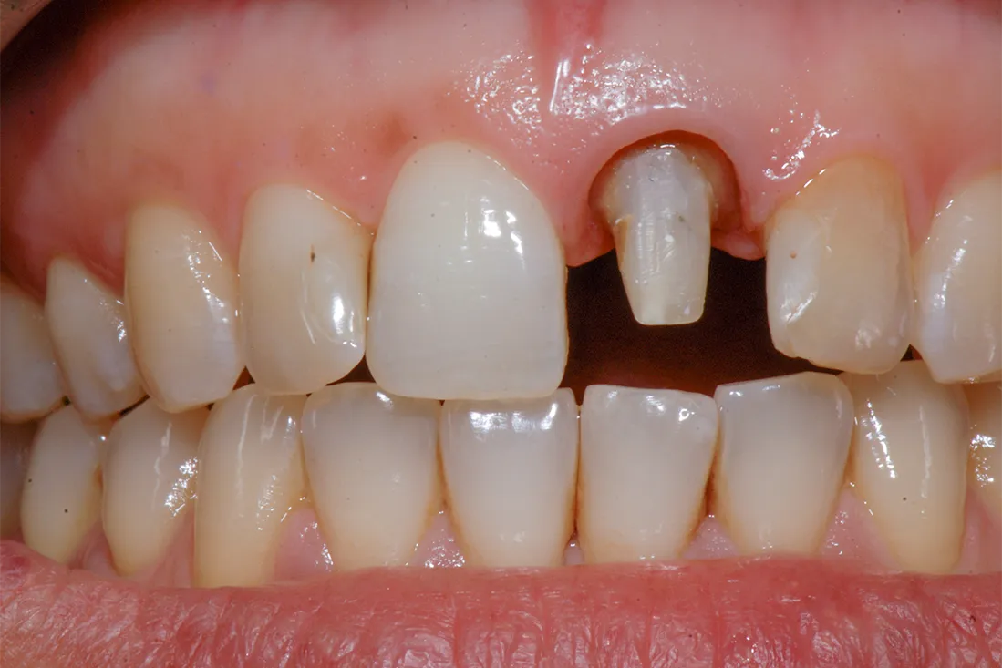 2 Faccette Dentali Frontali Michael Amodio Odontotecnico