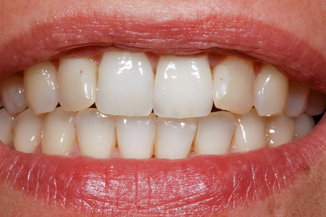3 Faccette Dentali Frontali Michael Amodio Odontotecnico