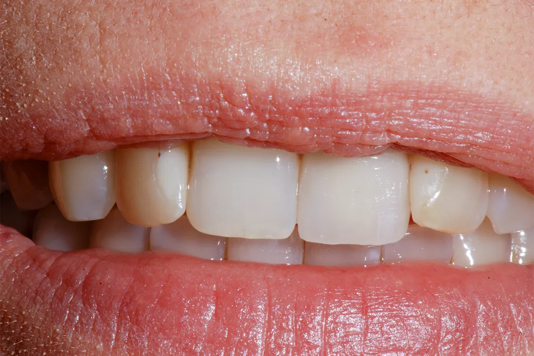 4 Faccette Dentali Frontali Michael Amodio Odontotecnico
